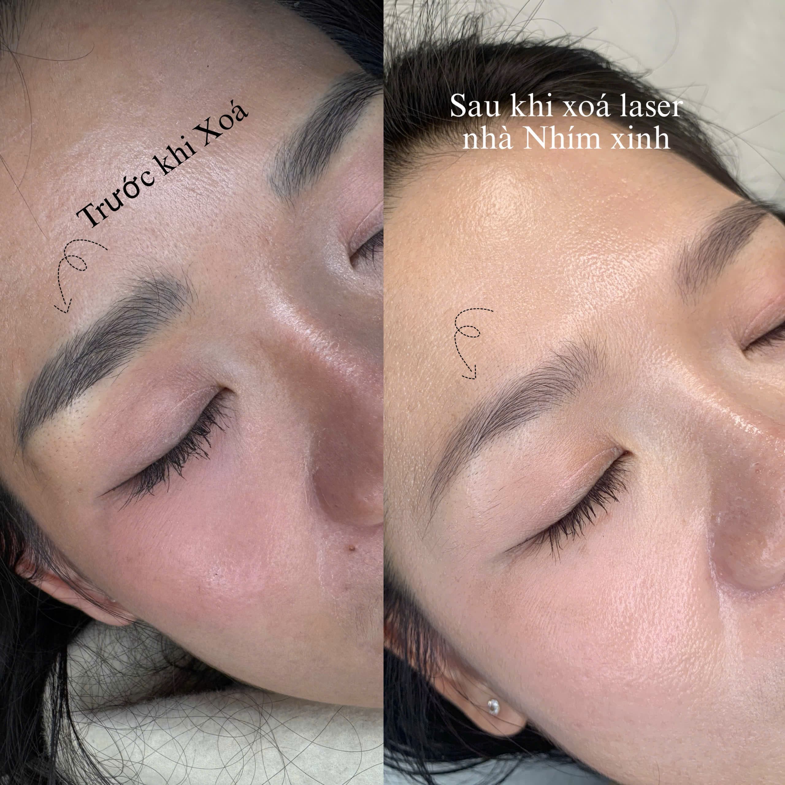 Xoá laser trục khuỷu
