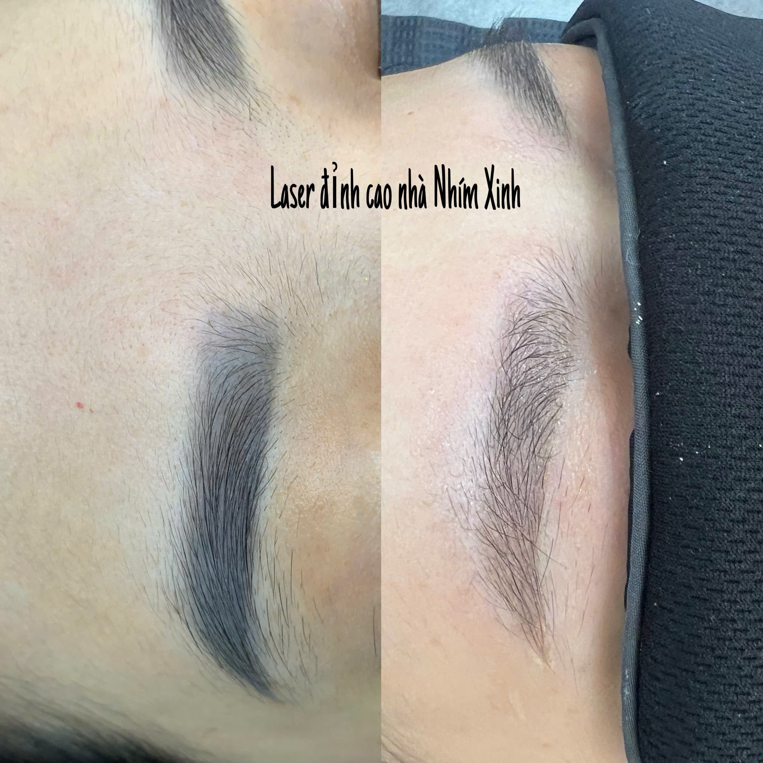 Xoá laser trục khuỷu — kết quả sau liệu trình