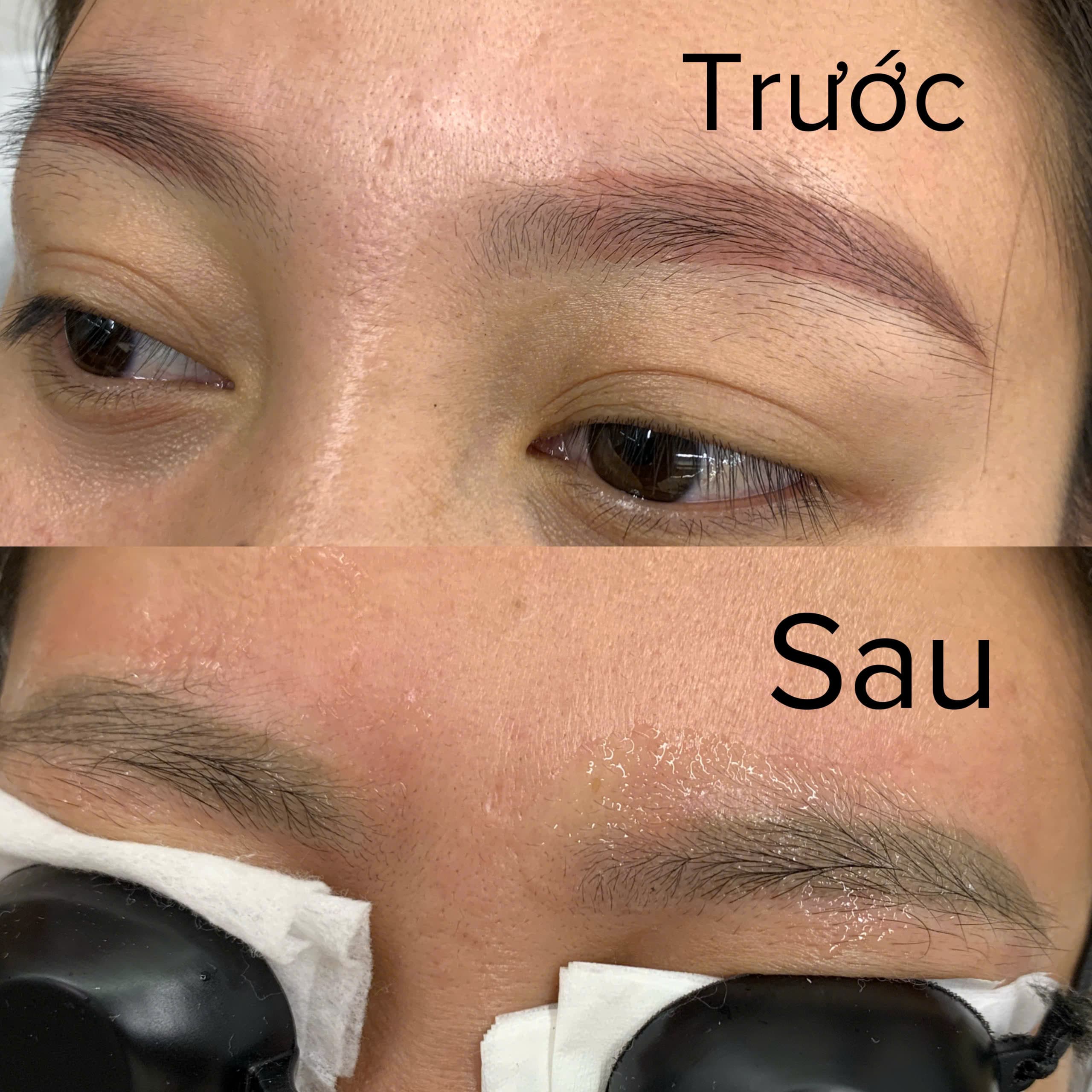 Xoá laser chân mày — trước & sau